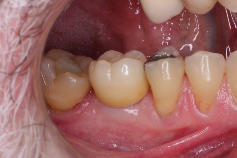 Fotografia intraoral