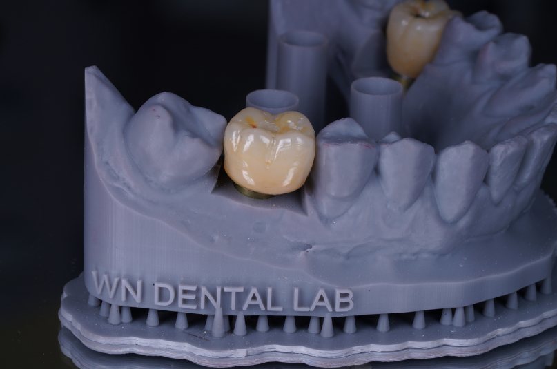 Modelo impresso em laboratório, com a coroa