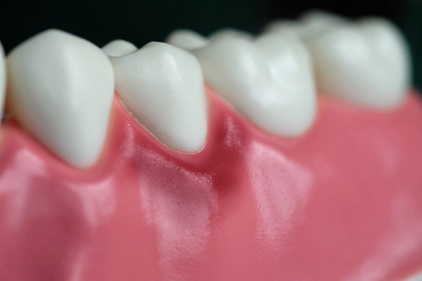 Gengiva ao redor dos dentes, em aproximação
