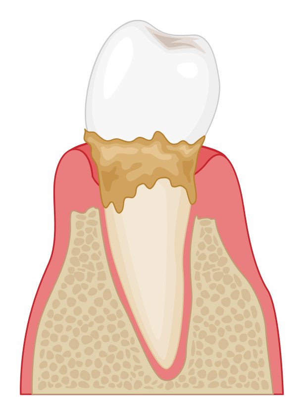 Ilustração esquemática de dente, gengiva e osso